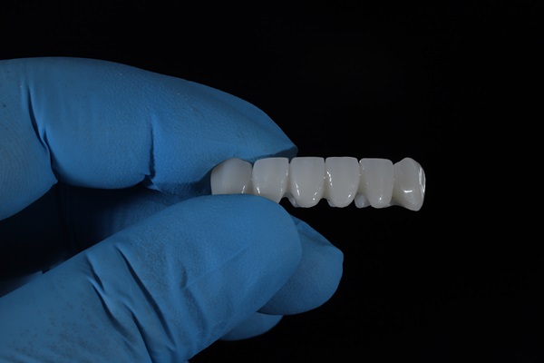 How A Dental Bridge Can Improve Your Oral Health